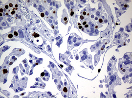 MKI67 / Ki67 Antibody - IHC of paraffin-embedded Carcinoma of Human bladder tissue using anti-MKI67 mouse monoclonal antibody.