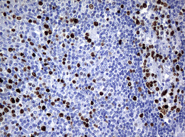 MKI67 / Ki67 Antibody - IHC of paraffin-embedded Human lymphoma tissue using anti-MKI67 mouse monoclonal antibody.