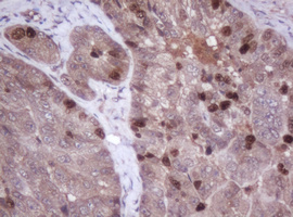 MKI67 / Ki67 Antibody - IHC of paraffin-embedded Adenocarcinoma of Human ovary tissue using anti-MKI67 mouse monoclonal antibody.