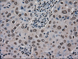 MKI67 / Ki67 Antibody - Immunohistochemical staining of paraffin-embedded Adenocarcinoma of breast tissue using anti-MKI67 mouse monoclonal antibody. (Dilution 1:50).