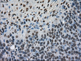 MKI67 / Ki67 Antibody - Immunohistochemical staining of paraffin-embedded Adenocarcinoma of ovary tissue using anti-MKI67 mouse monoclonal antibody. (Dilution 1:50).