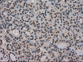 MKI67 / Ki67 Antibody - Immunohistochemical staining of paraffin-embedded Carcinoma of thyroid tissue using anti-MKI67 mouse monoclonal antibody. (Dilution 1:50).
