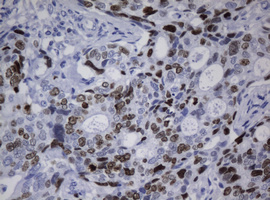 MKI67 / Ki67 Antibody - IHC of paraffin-embedded Adenocarcinoma of Human breast tissue using anti-${SYMBOL} mouse monoclonal antibody.
