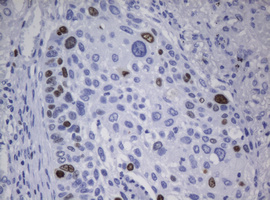 MKI67 / Ki67 Antibody - IHC of paraffin-embedded Carcinoma of Human lung tissue using anti-${SYMBOL} mouse monoclonal antibody.