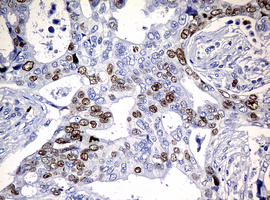 MKI67 / Ki67 Antibody - IHC of paraffin-embedded Adenocarcinoma of Human breast tissue using anti-MKI67 mouse monoclonal antibody.