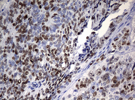 MKI67 / Ki67 Antibody - IHC of paraffin-embedded Adenocarcinoma of Human endometrium tissue using anti-MKI67 mouse monoclonal antibody.