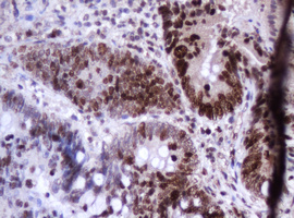 MKI67 / Ki67 Antibody - IHC of paraffin-embedded Adenocarcinoma of Human colon tissue using anti-MKI67 mouse monoclonal antibody.