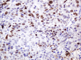 MKI67 / Ki67 Antibody - IHC of paraffin-embedded Adenocarcinoma of Human colon tissue using anti-MKI67 mouse monoclonal antibody.