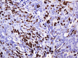 MKI67 / Ki67 Antibody - IHC of paraffin-embedded Adenocarcinoma of Human ovary tissue using anti-MKI67 mouse monoclonal antibody.