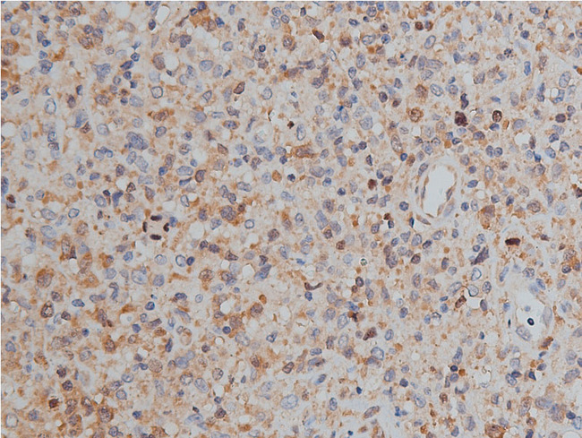 MKI67 / Ki67 Antibody - 1:50 staining human lymphoma tissue by IHC-P. The tissue was formaldehyde fixed and a heat mediated antigen retrieval step in citrate buffer was performed. The tissue was then blocked and incubated with the antibody for 1.5 hours at 22°C. An HRP conjugated goat anti-rabbit antibody was used as the secondary.