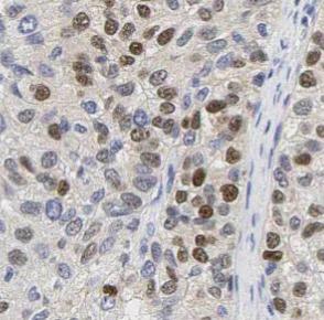 MKI67 / Ki67 Antibody - Immunohistochemistry of paraffin-embedded human breast cancer tissue slide using KI67 antibody at dilution of 1:200