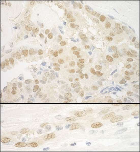 MKL2 Antibody - Detection of Human MKL2 by Immunohistochemistry. Sample: FFPE section of human prostate carcinoma and linitis plastica stomach cancer. Antibody: Affinity purified rabbit anti-MKL2 used at a dilution of 1:200 (1and 1:1000 (0.2 Detection: DAB.
