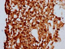 MKL2 Antibody - Immunohistochemistry Dilution at 1:500 and staining in paraffin-embedded human melanoma cancer performed on a Leica BondTM system. After dewaxing and hydration, antigen retrieval was mediated by high pressure in a citrate buffer (pH 6.0). Section was blocked with 10% normal Goat serum 30min at RT. Then primary antibody (1% BSA) was incubated at 4°C overnight. The primary is detected by a biotinylated Secondary antibody and visualized using an HRP conjugated SP system.