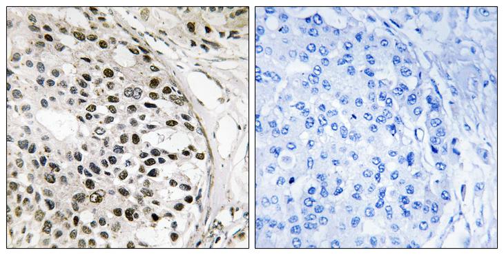 MKNK1 / MNK1 Antibody - Peptide - + Immunohistochemistry analysis of paraffin-embedded human breast carcinoma tissue using MNK1 antibody.