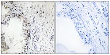 MKNK1 / MNK1 Antibody - P-peptide - + Immunohistochemistry analysis of paraffin-embedded human breast carcinoma tissue, using MNK1 (Phospho-Thr250) antibody.