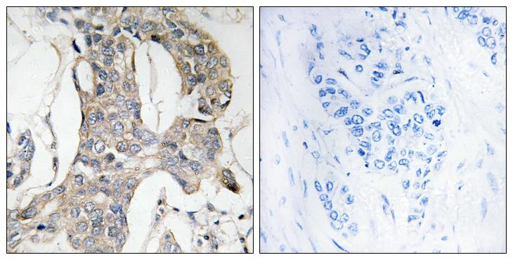 MKP1 + MKP2 Antibody - P-peptide - + Immunohistochemistry analysis of paraffin-embedded human breast carcinoma tissue using MKP-1/2 (Phospho-Ser296/318) antibody.