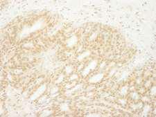 MKRN1 Antibody - Detection of Human MKRN1 by Immunohistochemistry. Sample: FFPE section of human breast carcinoma. Antibody: Affinity purified rabbit anti-MKRN1 used at a dilution of 1:1000 (1 ug/ml). Detection: DAB.