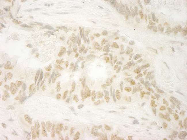 MKRN1 Antibody - Detection of Human MKRN1 by Immunohistochemistry. Sample: FFPE section of human lung carcinoma. Antibody: Affinity purified rabbit anti-MKRN1 used at a dilution of 1:500. Epitope Retrieval Buffer-High pH (IHC-101J) was substituted for Epitope Retrieval Buffer-Reduced pH.