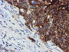 MKRN1 Antibody - IHC of paraffin-embedded Adenocarcinoma of Human breast tissue using anti-MKRN1 mouse monoclonal antibody.