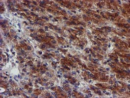 MKRN1 Antibody - IHC of paraffin-embedded Carcinoma of Human liver tissue using anti-MKRN1 mouse monoclonal antibody.