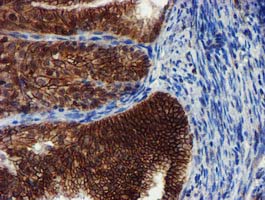 MKRN1 Antibody - IHC of paraffin-embedded Adenocarcinoma of Human endometrium tissue using anti-MKRN1 mouse monoclonal antibody.