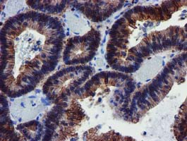 MKRN1 Antibody - IHC of paraffin-embedded Adenocarcinoma of Human colon tissue using anti-MKRN1 mouse monoclonal antibody.