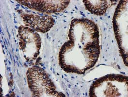 MKRN1 Antibody - IHC of paraffin-embedded Carcinoma of Human prostate tissue using anti-MKRN1 mouse monoclonal antibody.