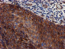 MKRN1 Antibody - IHC of paraffin-embedded Carcinoma of Human bladder tissue using anti-MKRN1 mouse monoclonal antibody.
