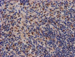 MKRN1 Antibody - IHC of paraffin-embedded Human lymphoma tissue using anti-MKRN1 mouse monoclonal antibody.