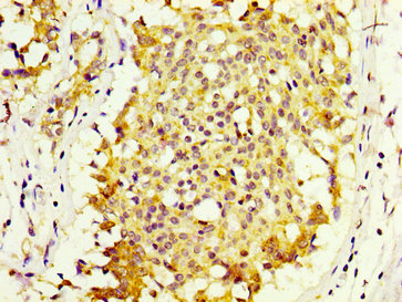 MKRN1 Antibody - Immunohistochemistry image at a dilution of 1:600 and staining in paraffin-embedded human breast cancer performed on a Leica BondTM system. After dewaxing and hydration, antigen retrieval was mediated by high pressure in a citrate buffer (pH 6.0) . Section was blocked with 10% normal goat serum 30min at RT. Then primary antibody (1% BSA) was incubated at 4 °C overnight. The primary is detected by a biotinylated secondary antibody and visualized using an HRP conjugated SP system.