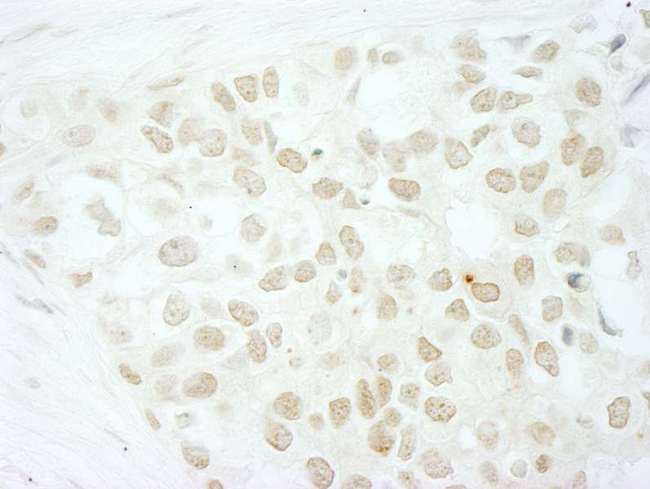 MKRN2 Antibody - Detection of Human MKRN2 by Immunohistochemistry. Sample: FFPE section of human breast carcinoma. Antibody: Affinity purified rabbit anti-MKRN2 used at a dilution of 1:1000 (1 Detection: DAB.