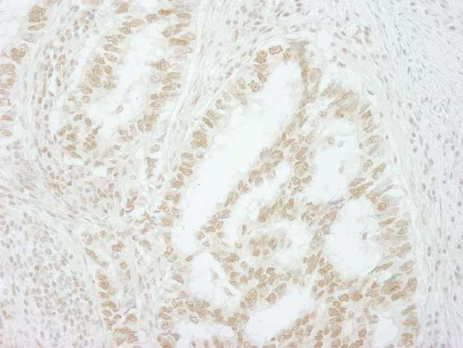 MKRN2 Antibody - Detection of Human MKRN2 by Immunohistochemistry. Sample: FFPE section of human lung carcinoma. Antibody: Affinity purified rabbit anti-MKRN2 used at a dilution of 1:500. Epitope Retrieval Buffer-High pH (IHC-101J) was substituted for Epitope Retrieval Buffer-Reduced pH.