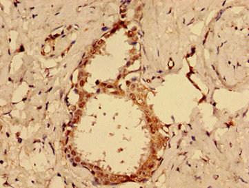 MKRN2 Antibody - Immunohistochemistry image of paraffin-embedded human ovarian cancer at a dilution of 1:100