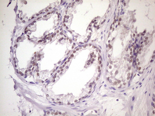 MKX Antibody - Immunohistochemical staining of paraffin-embedded Carcinoma of Human prostate tissue using anti-MKX mouse monoclonal antibody. (Heat-induced epitope retrieval by 1 mM EDTA in 10mM Tris, pH8.5, 120C for 3min. (1:150)