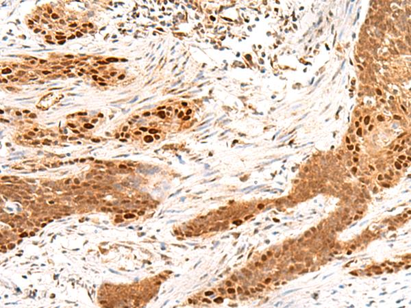 MKX Antibody - Immunohistochemistry of paraffin-embedded Human esophagus cancer tissue  using MKX Polyclonal Antibody at dilution of 1:50(×200)