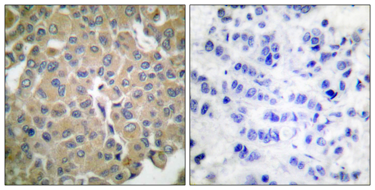 MLANA / Melan-A Antibody - Immunohistochemistry analysis of paraffin-embedded human breast carcinoma tissue, using MART-1 Antibody. The picture on the right is blocked with the synthesized peptide.