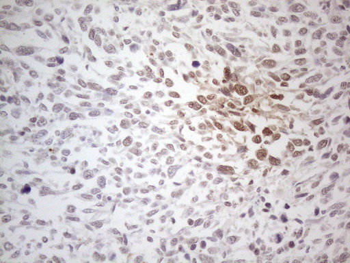 MLANA / Melan-A Antibody - Immunohistochemical staining of paraffin-embedded Human melanoma tissue using anti-MLANA mouse monoclonal antibody. (Heat-induced epitope retrieval by 1mM EDTA in 10mM Tris buffer. (pH8.5) at 120 oC for 3 min. (1:150)
