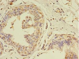 MLANA / Melan-A Antibody - Immunohistochemistry of paraffin-embedded human breast cancer using antibody at 1:100 dilution.  This image was taken for the unconjugated form of this product. Other forms have not been tested.