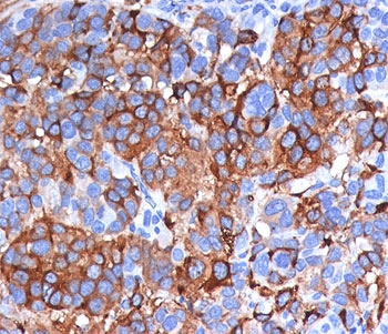MLANA / Melan-A Antibody - IHC testing of human melanoma stained with Melan-A antibody (A103). Note cytoplasmic staining of cells.
