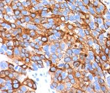 MLANA / Melan-A Antibody - MART-1 Melan-A antibody A103 + M2-7C10 + M2-9E3 immunohistochemistry.  This image was taken for the unmodified form of this product. Other forms have not been tested.