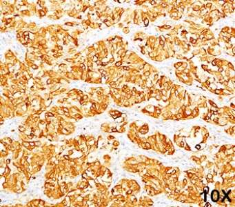 MLANA / Melan-A Antibody - MART-1 antibody M2-7C10 immunohistochemistry.  This image was taken for the unmodified form of this product. Other forms have not been tested.