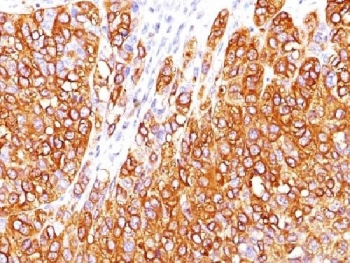 MLANA / Melan-A Antibody - IHC testing of human melanoma stained with MART-1 antibody (M2-7C10). Note cytoplasmic staining of cells.