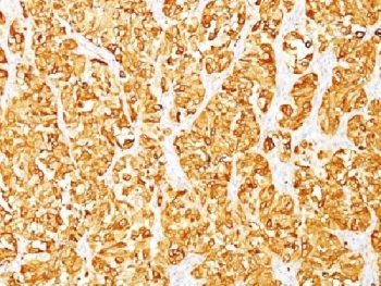 MLANA / Melan-A Antibody - IHC testing of human melanoma stained with MART-1 antibody (M2-7C10). Note cytoplasmic staining of cells.