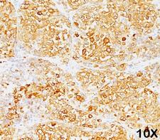 MLANA / Melan-A Antibody - MART-1 Melan-A antibody M2-9E3 immunohistochemistry 1.  This image was taken for the unmodified form of this product. Other forms have not been tested.