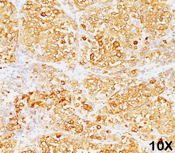 MLANA / Melan-A Antibody - MART-1 Melan-A antibody M2-9E3 immunohistochemistry 1.  This image was taken for the unmodified form of this product. Other forms have not been tested.