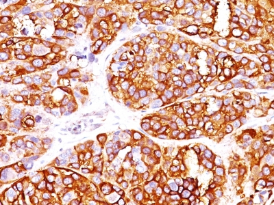 MLANA / Melan-A Antibody - Formalin-fixed, paraffin-embedded human Melanoma stained with MART-1 Rabbit Recombinant Monoclonal Antibody (MLANA/1409R).
