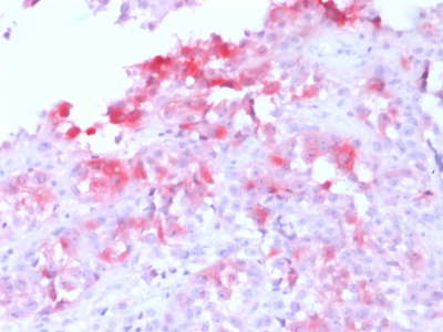 MLANA / Melan-A Antibody - Formalin-fixed, paraffin-embedded Human Melanoma stained with MART-1 Rabbit Recombinant Monoclonal Antibody (MLANA/1761R) (AP-Fast Red).