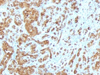 MLANA / Melan-A Antibody - Formalin-fixed, paraffin-embedded human melanoma stained with Melan-A antibody (MLANA/788).  This image was taken for the unmodified form of this product. Other forms have not been tested.