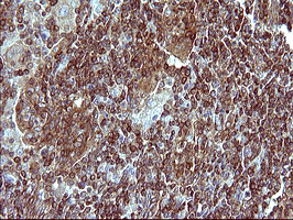 MLANA / Melan-A Antibody - IHC of paraffin-embedded Human lymphoma tissue using anti-MLANA mouse monoclonal antibody. (Heat-induced epitope retrieval by 10mM citric buffer, pH6.0, 120°C for 3min).