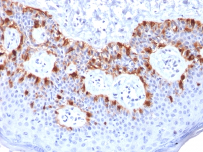 MLANA / Melan-A Antibody - Formalin-fixed, paraffin-embedded human Melanoma stained with MART-1 Mouse Recombinant Monoclonal Antibody (rMLANA/788).